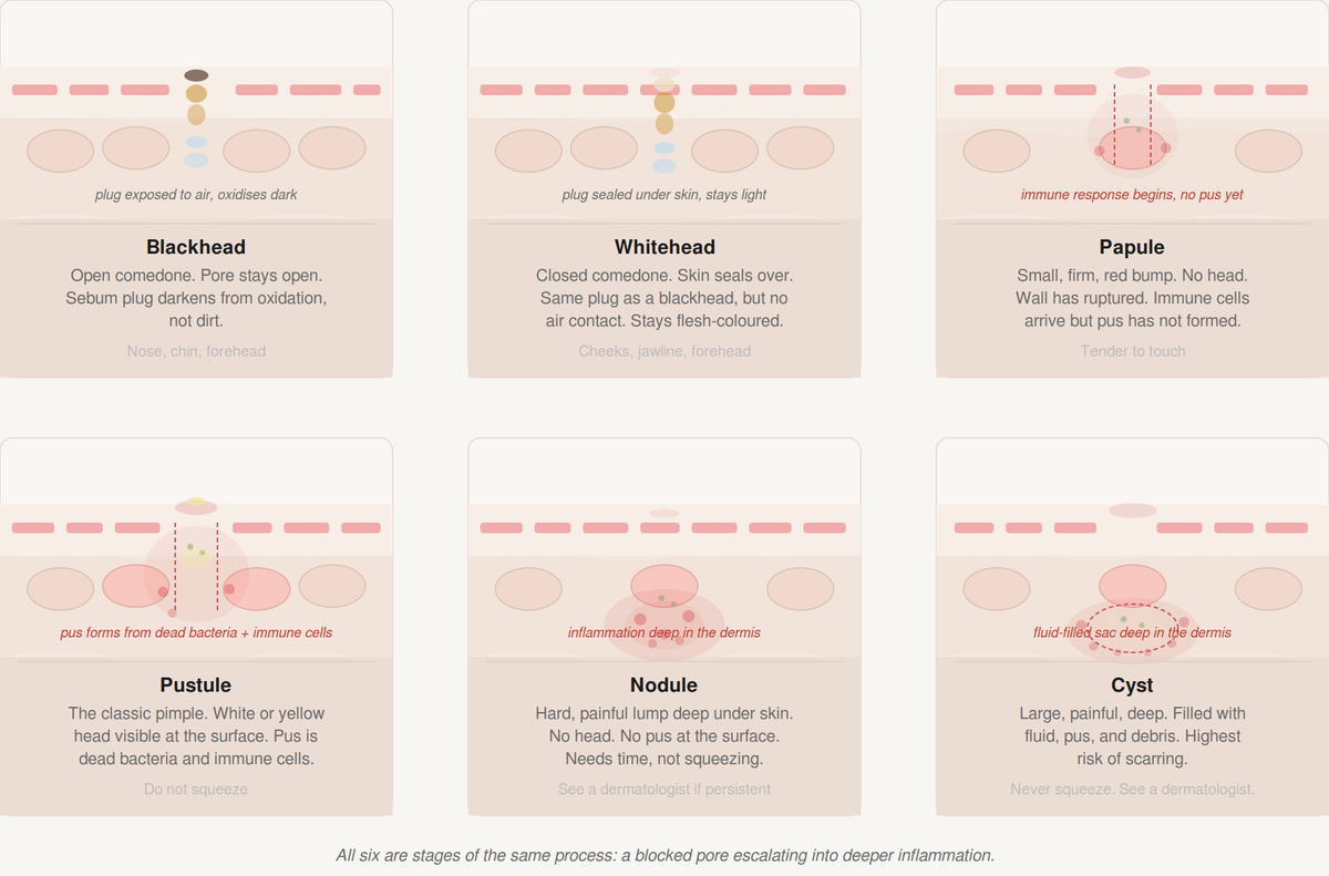 Pimples on Face: Types, Causes and How to Actually Get Rid of Them