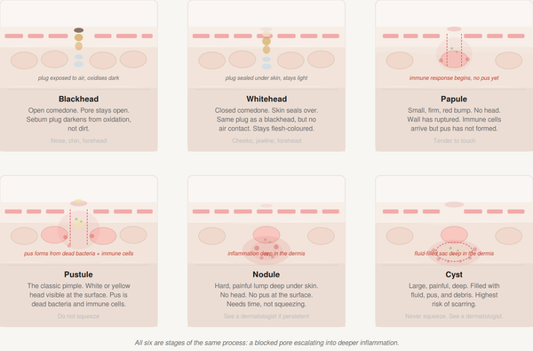Pimples on Face: Types, Causes and How to Actually Get Rid of Them